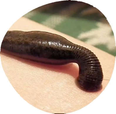 Raktamokshana (Leech Therapy)